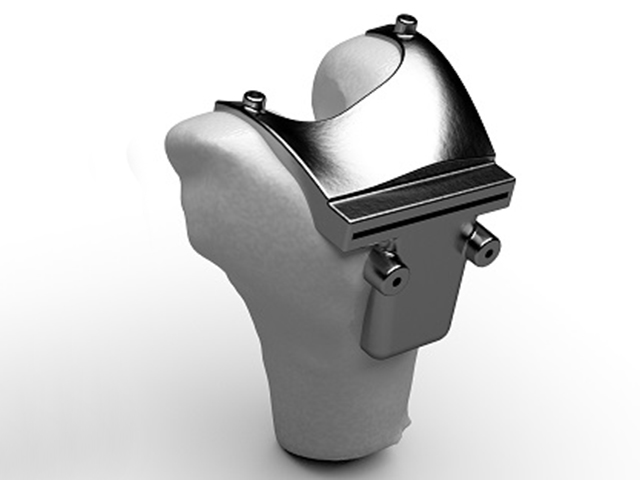 Image 3D d'un dispositif médical fixé à un os humain.