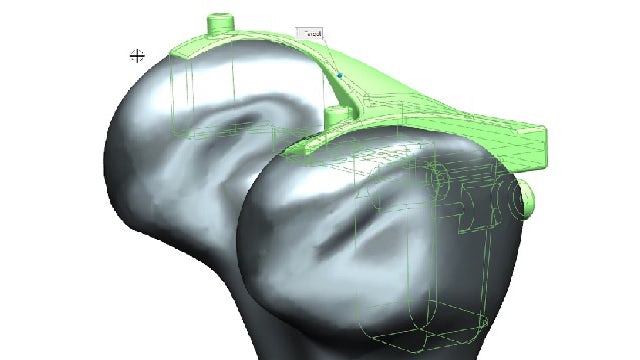 A 3D NX CAD model showing the top of a femur bone in gray and a metal knee replacement in green.