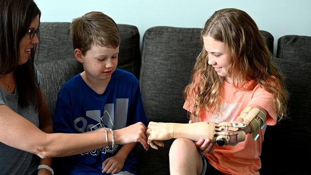 Unlimited tomorrow prosthetic arm patient