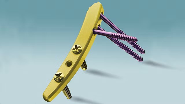 Vykreslení intramedulárního fixačního implantátu MICRONAIL® v řešení NX