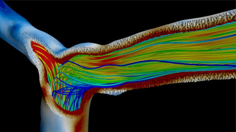 Fluid-Struktur-Interaktion in einer intrakraniellen Bifurkation