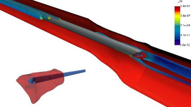 Vyhodnocení hemodialyzačního katétru optimalizovaného pro CFD na virtuálních pacientech s různými anatomiemi