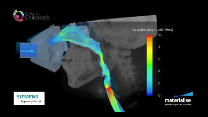 Simulating airflow in dynamic airway models: Using CFD for diagnosis and intervention planning